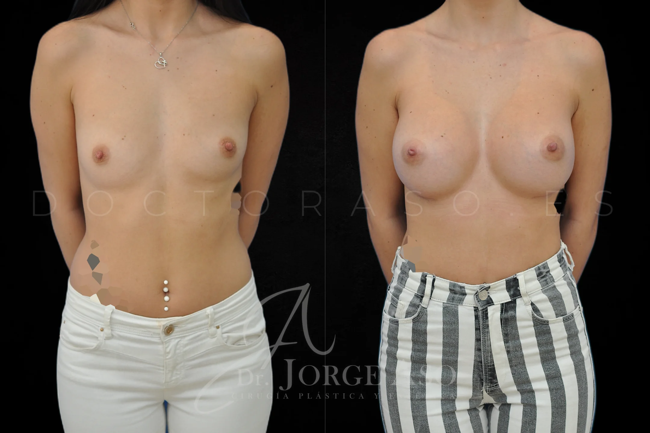 Aumento de pecho con protesis Anatómicas de 425 cc perfil Extra alto vista frontal