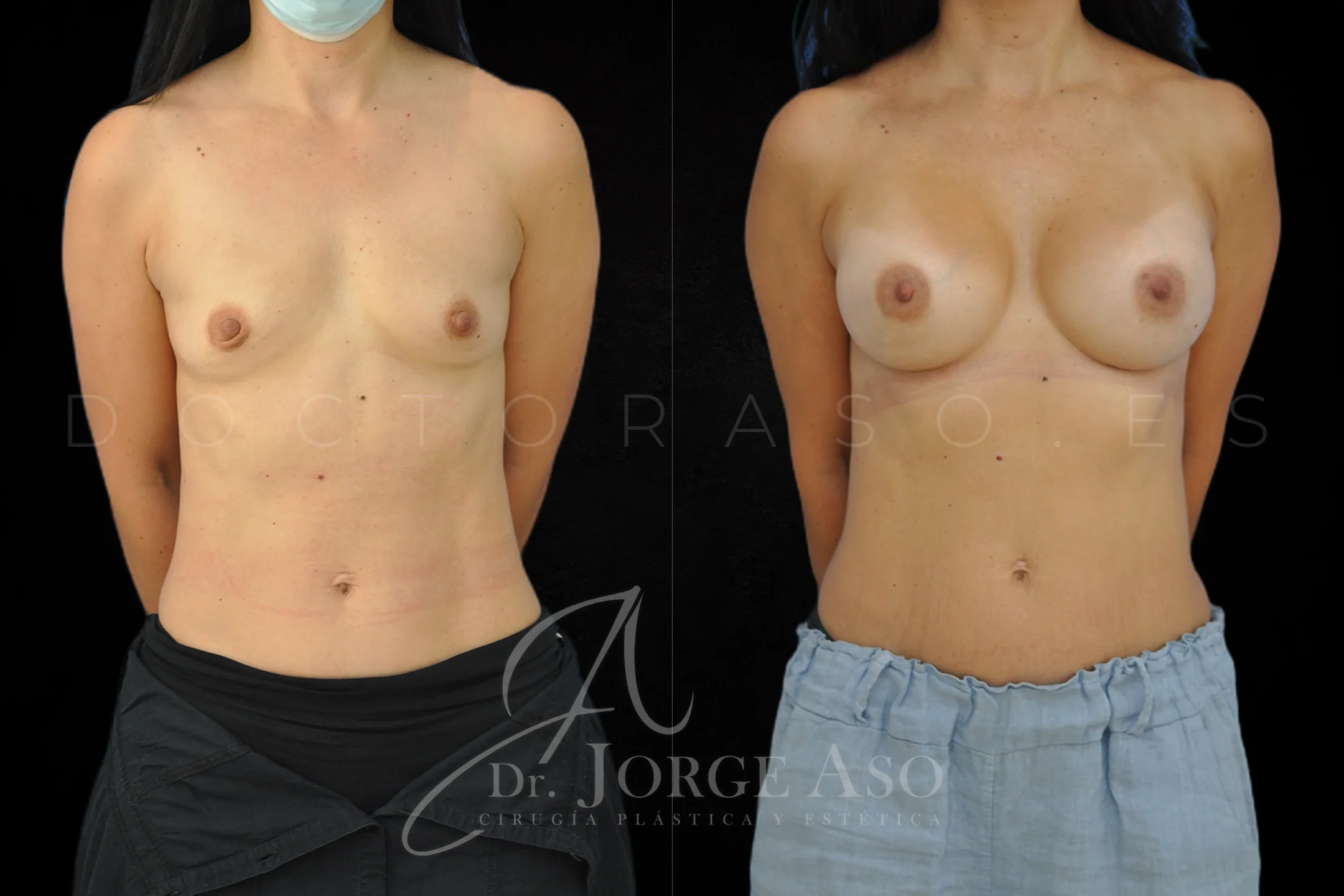 Aumento de pecho con protesis Anatómicas de 425 cc perfil Extra alto vista frontal