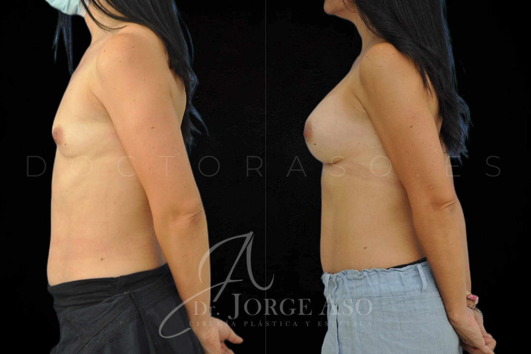 Aumento de pecho con protesis Anatómicas de 425 cc perfil Extra alto vista lateral