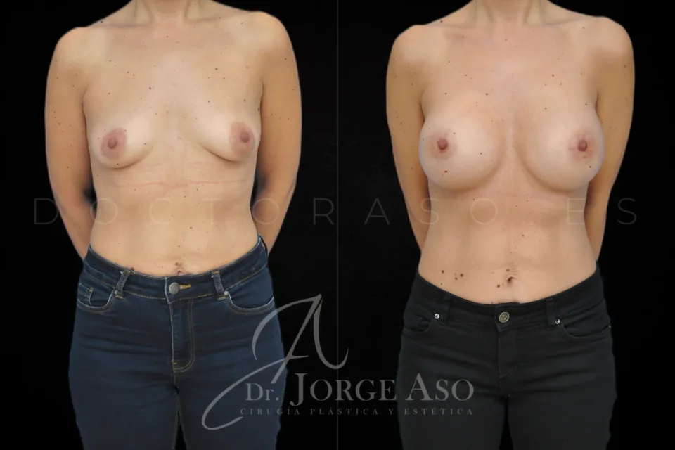 Aumento de pecho antes y después, prótesis anatómicas, 425 cc, perfil extra alto, vista frontal