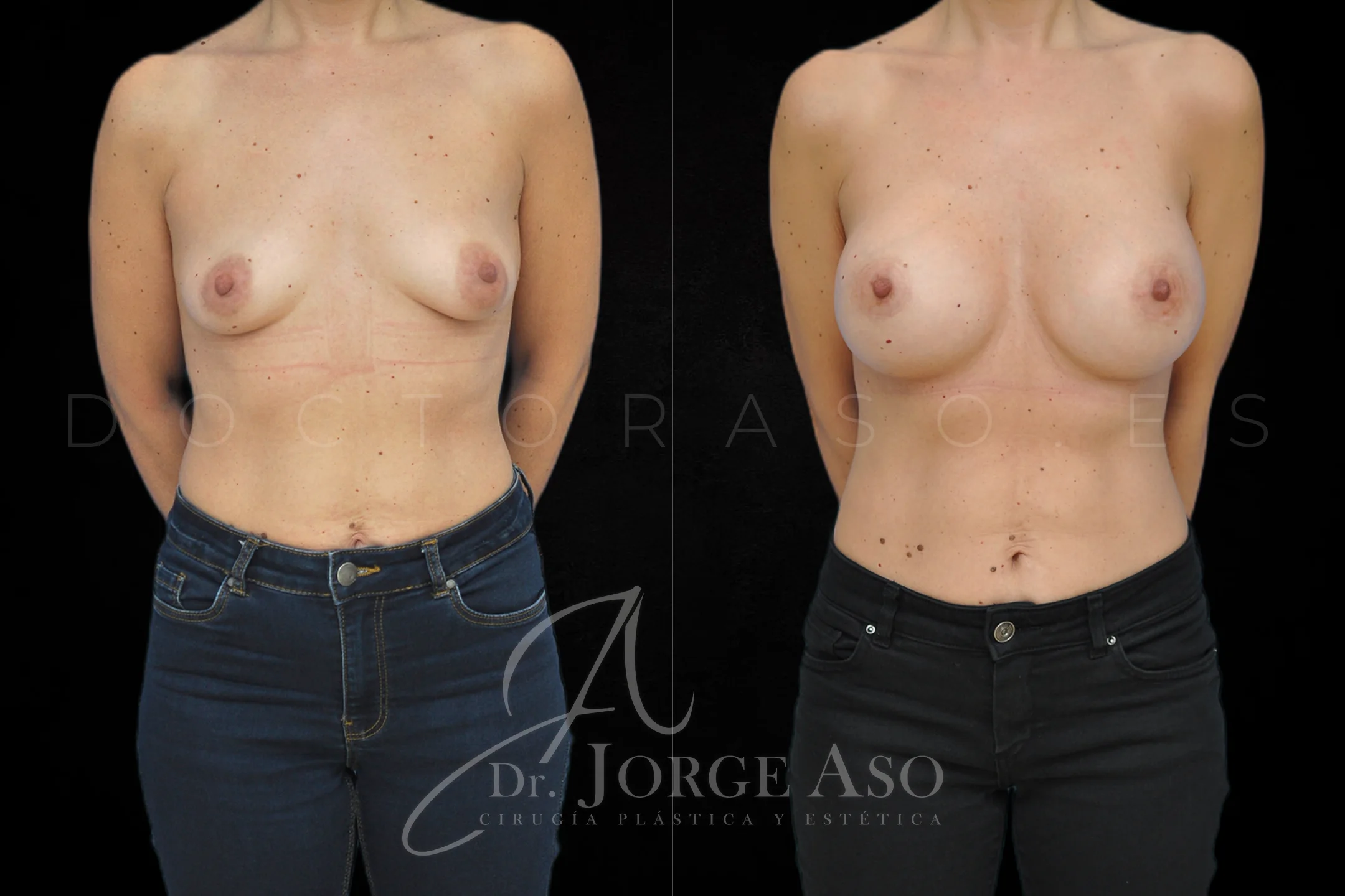 Aumento de pecho con protesis Anatómicas de 425 cc perfil Extra alto vista frontal