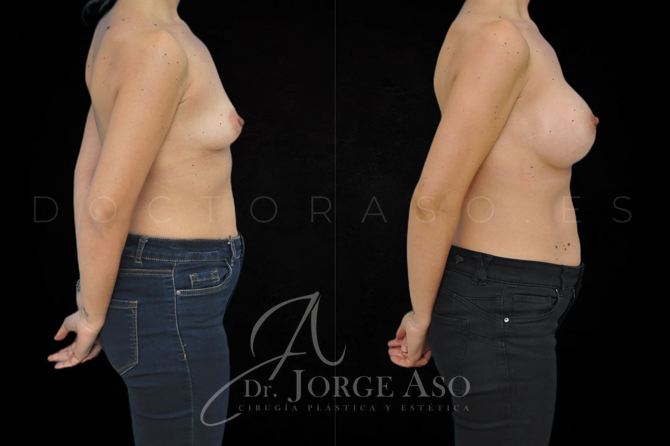 Aumento de pecho con protesis Anatómicas de 425 cc perfil Extra alto vista lateral