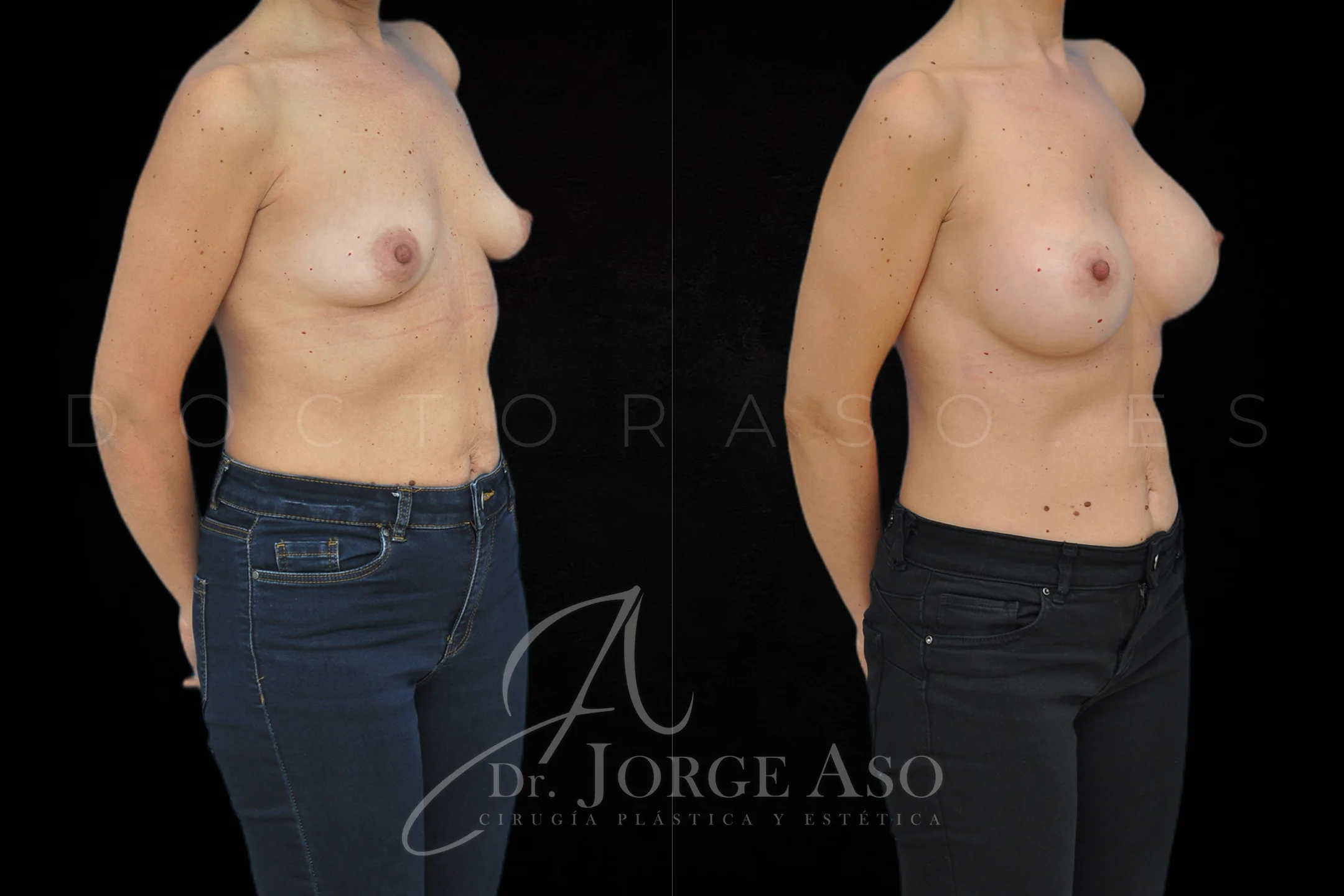 Aumento de pecho con protesis Anatómicas de 425 cc perfil Extra alto vista oblicua