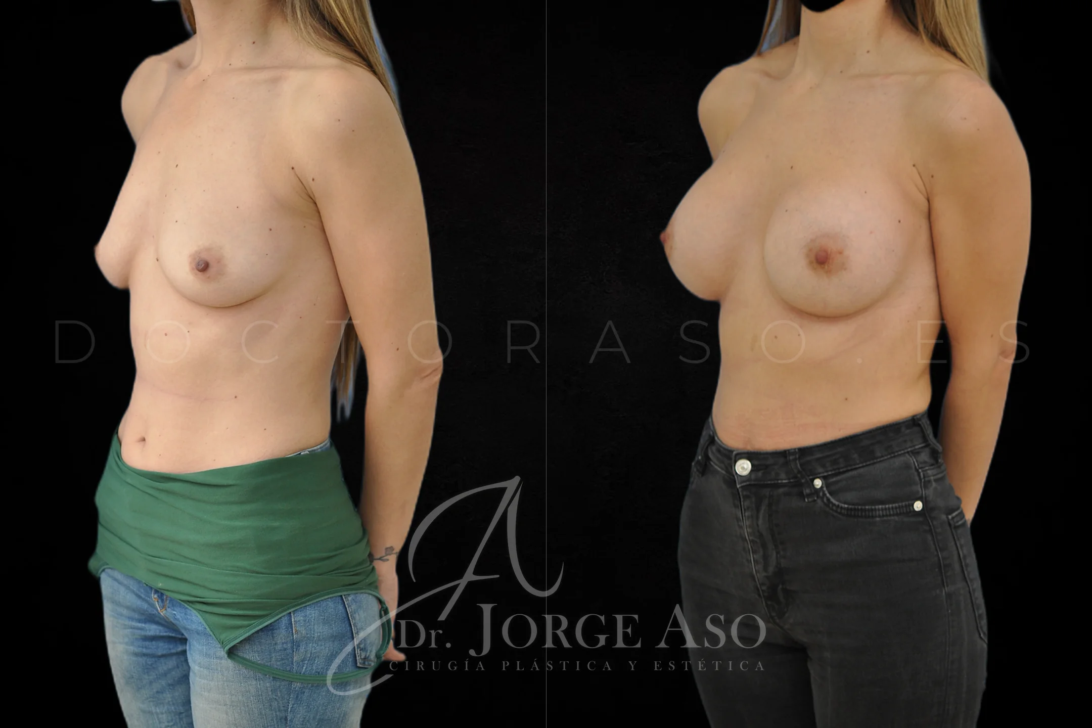 Aumento de pecho con protesis Anatómicas de 425 cc perfil Extra alto vista oblicua