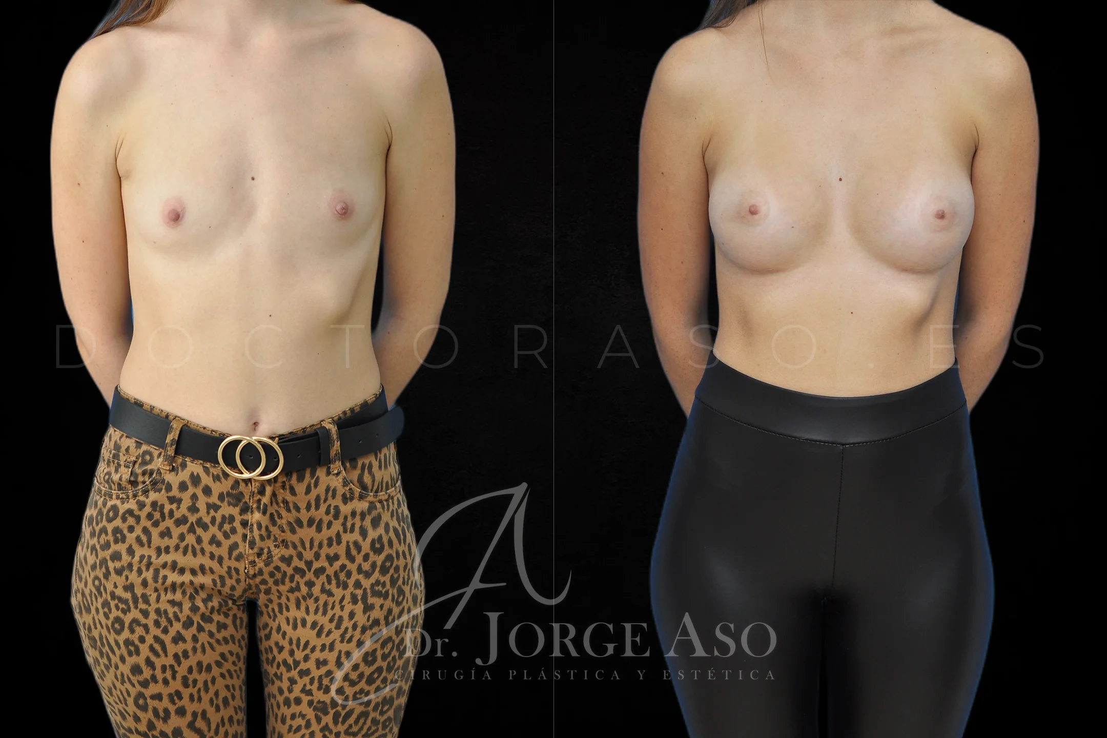 Aumento de pecho con protesis Anatómicas de 425 cc perfil Extra alto vista frontal