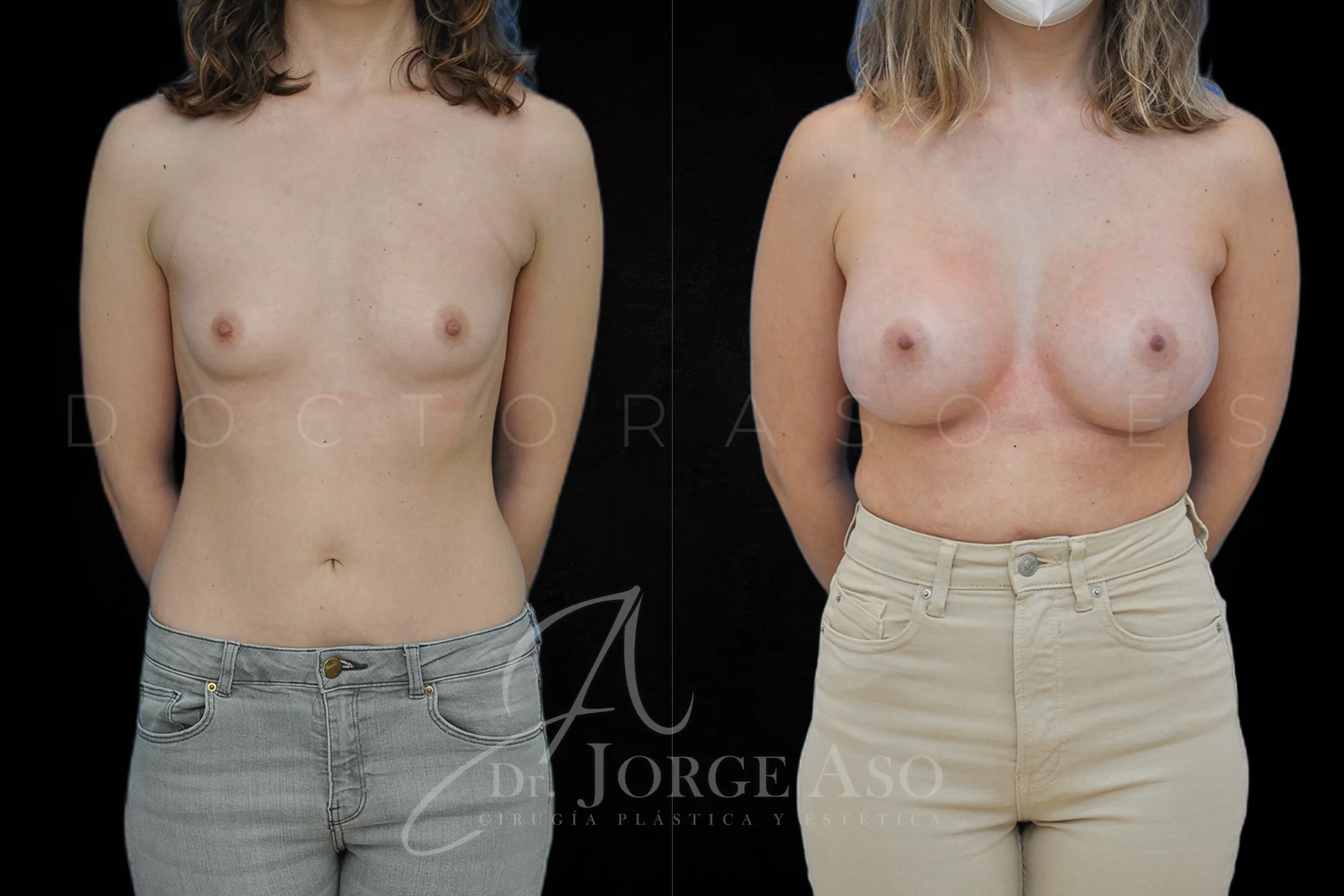 Aumento de pecho con protesis Anatómicas de 425 cc perfil Extra alto vista frontal