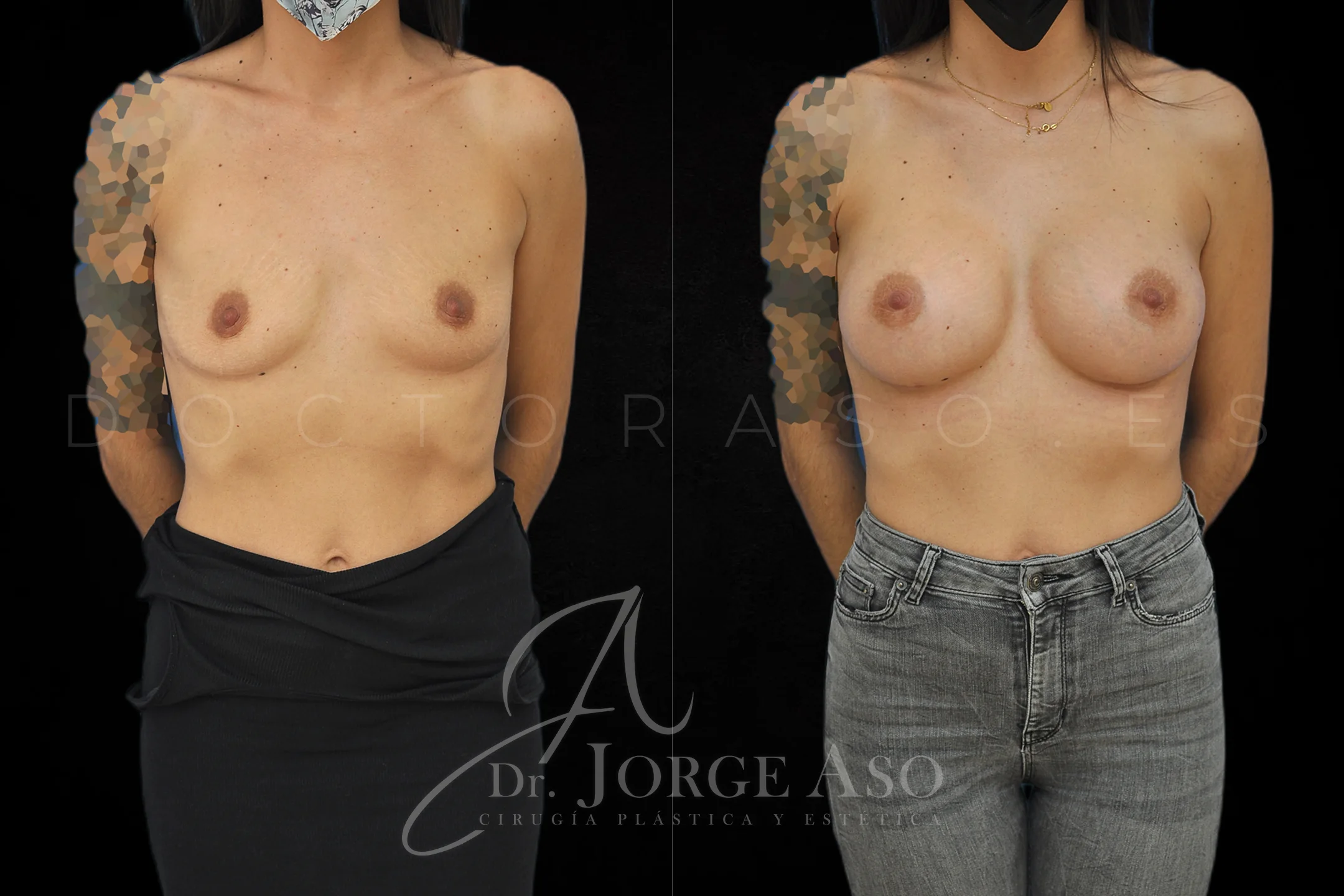 Aumento de pecho con protesis Anatómicas de 445 cc perfil Alto vista frontal