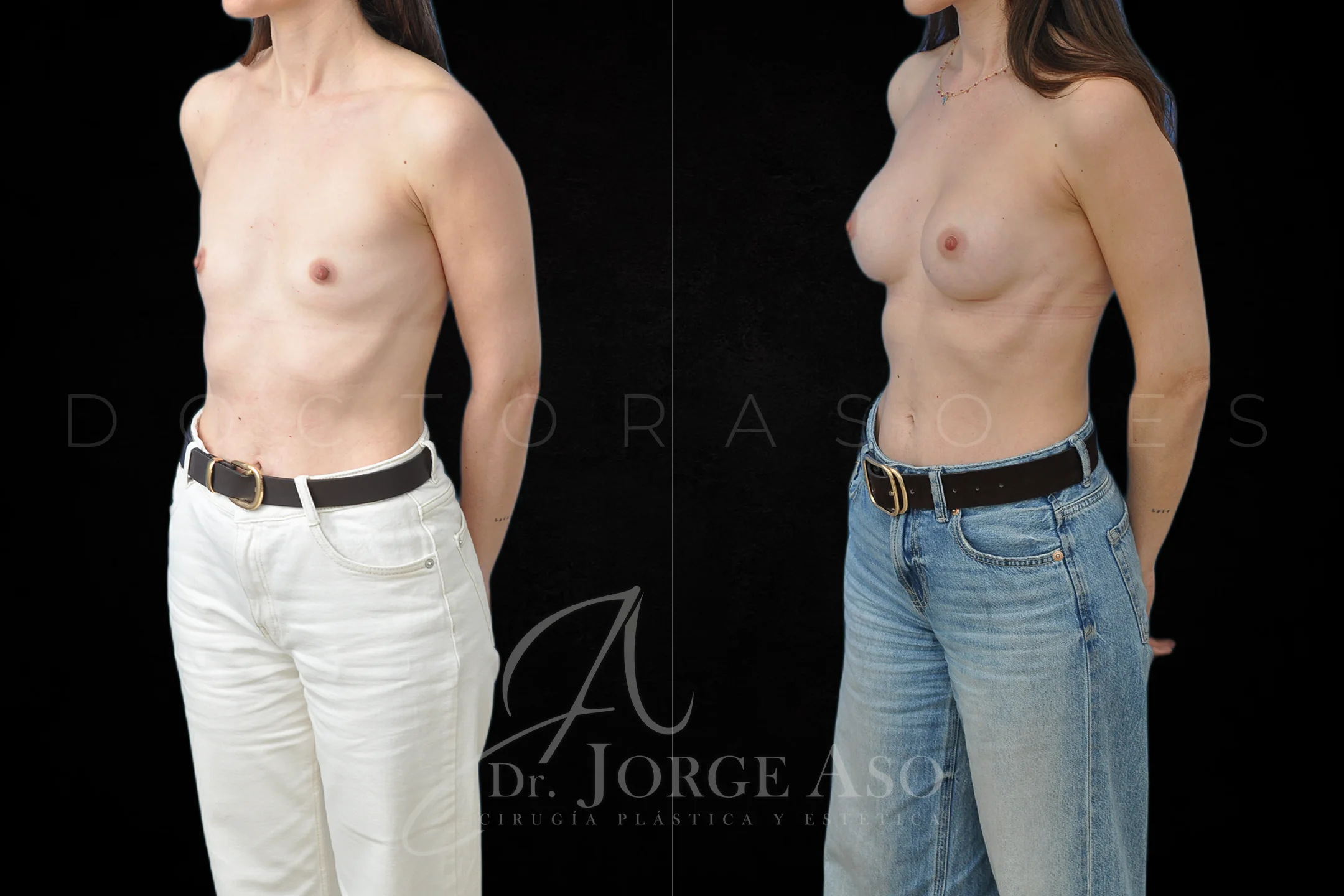 Aumento de pecho con protesis Ergonómicas de 225 cc perfil Moderado (Demi Motiva) vista oblicua