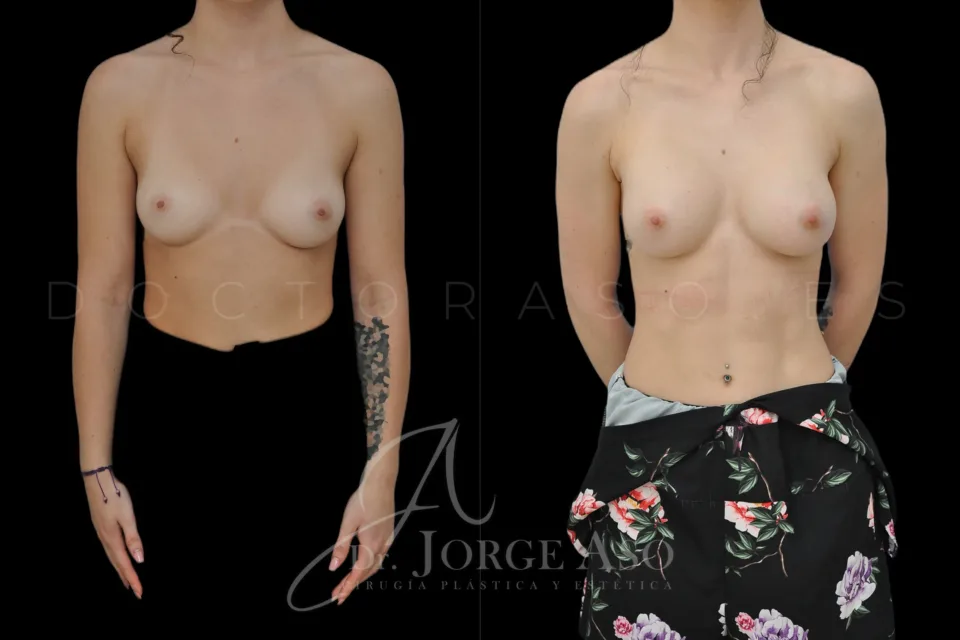 Clinical case of breast augmentation with 250 cc ergonomic implants, moderate (demi motiva) profile, front view, before and after.