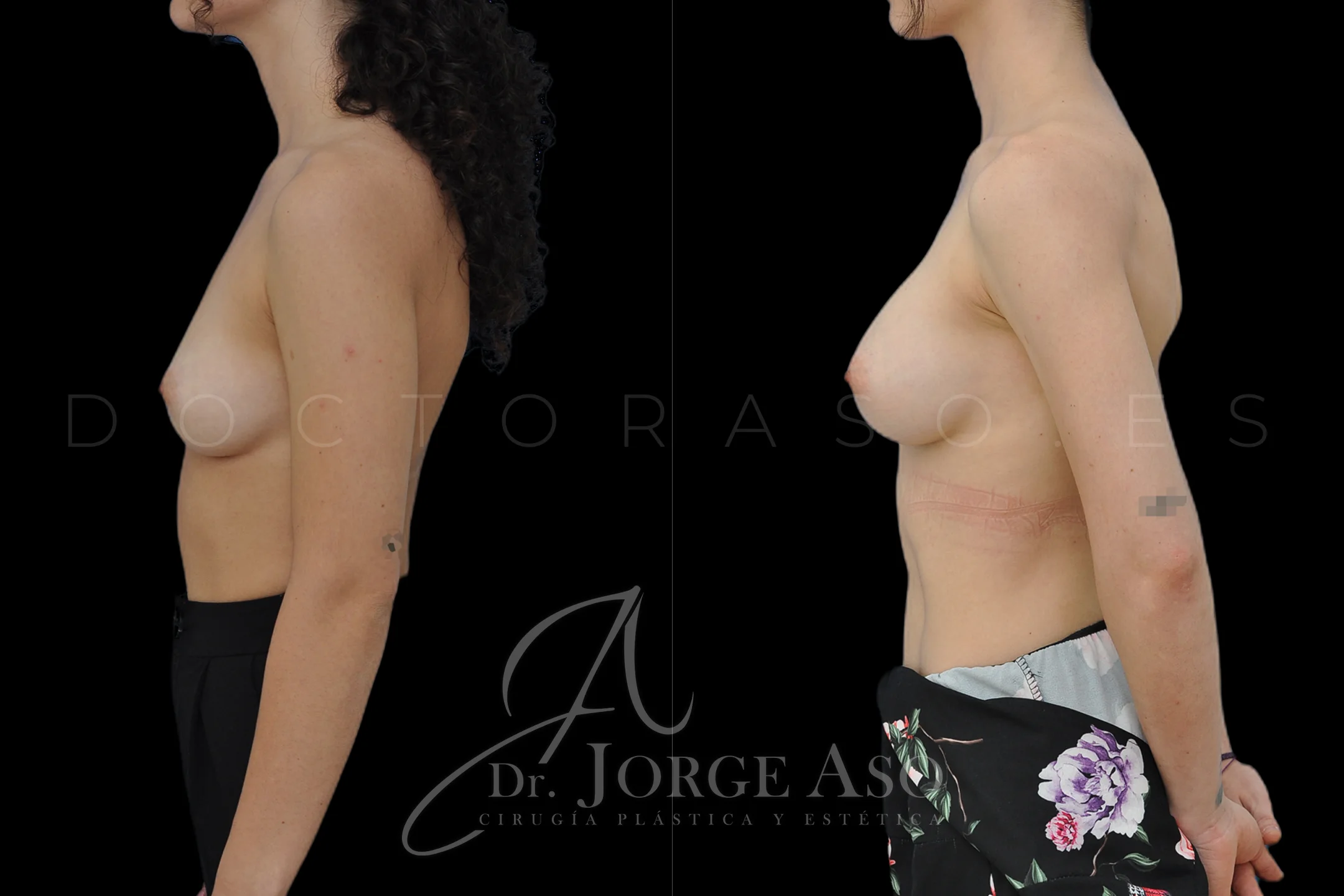 Aumento de pecho con protesis Ergonómicas de 250 cc perfil Moderado (Demi Motiva) vista lateral