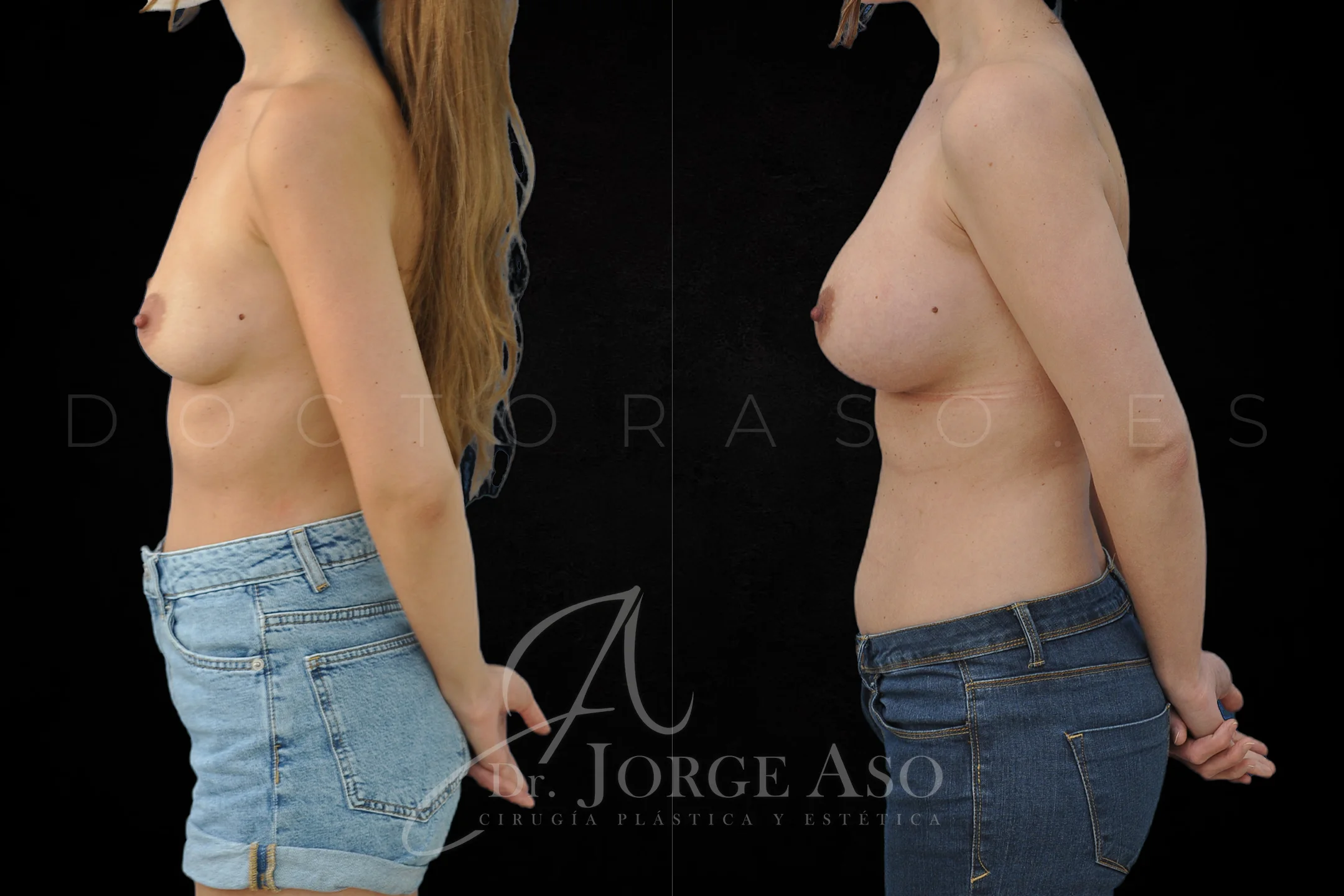 Aumento de pecho con protesis Ergonómicas de 350 cc perfil Alto (High Motiva) vista lateral