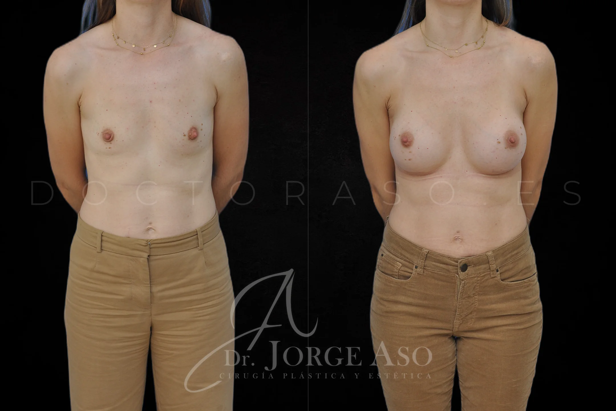 Aumento de pecho con protesis Ergonómicas de 400 cc perfil Alto (High Motiva) vista frontal