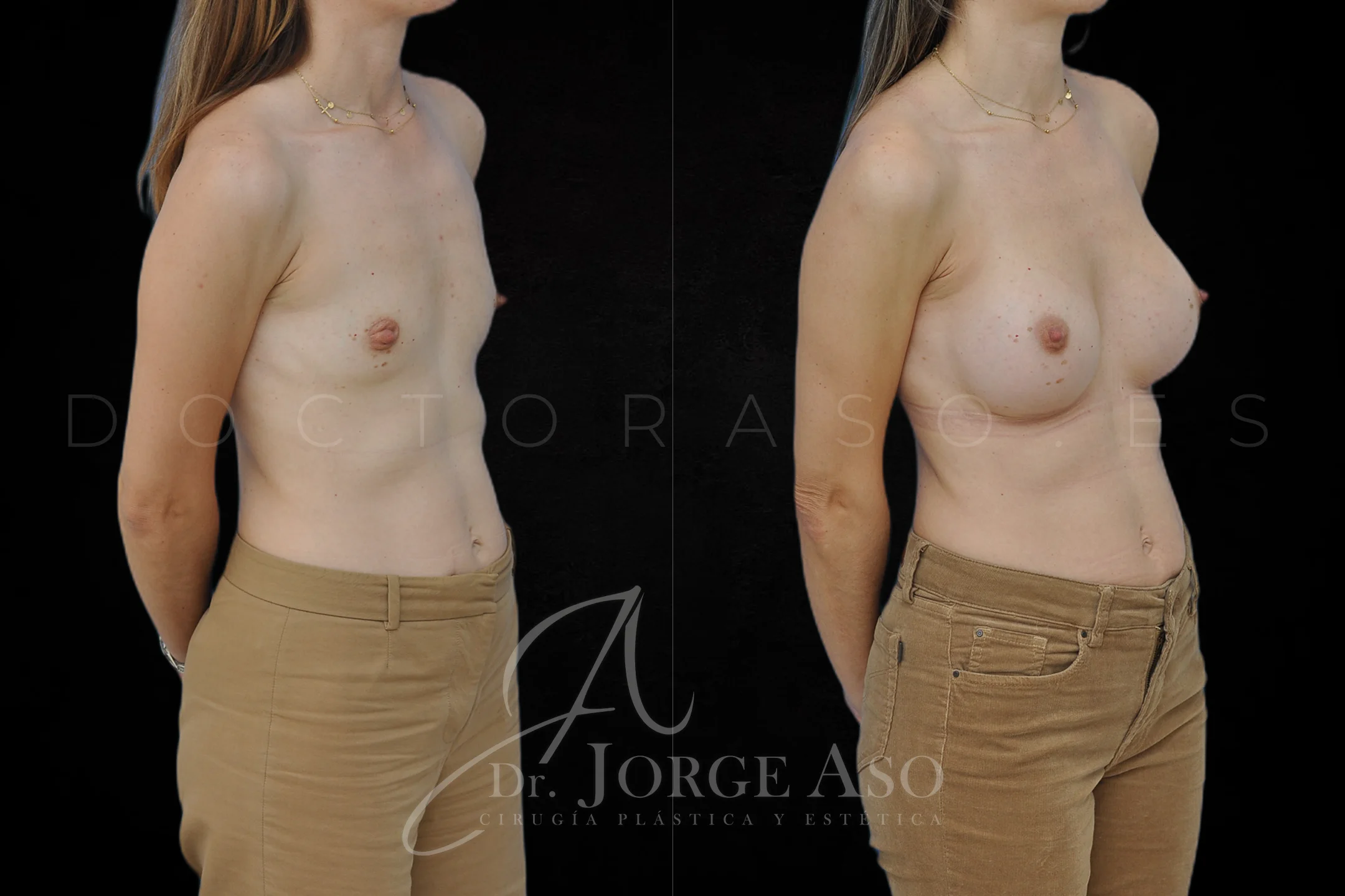 Aumento de pecho con protesis Ergonómicas de 400 cc perfil Alto (High Motiva) vista oblicua