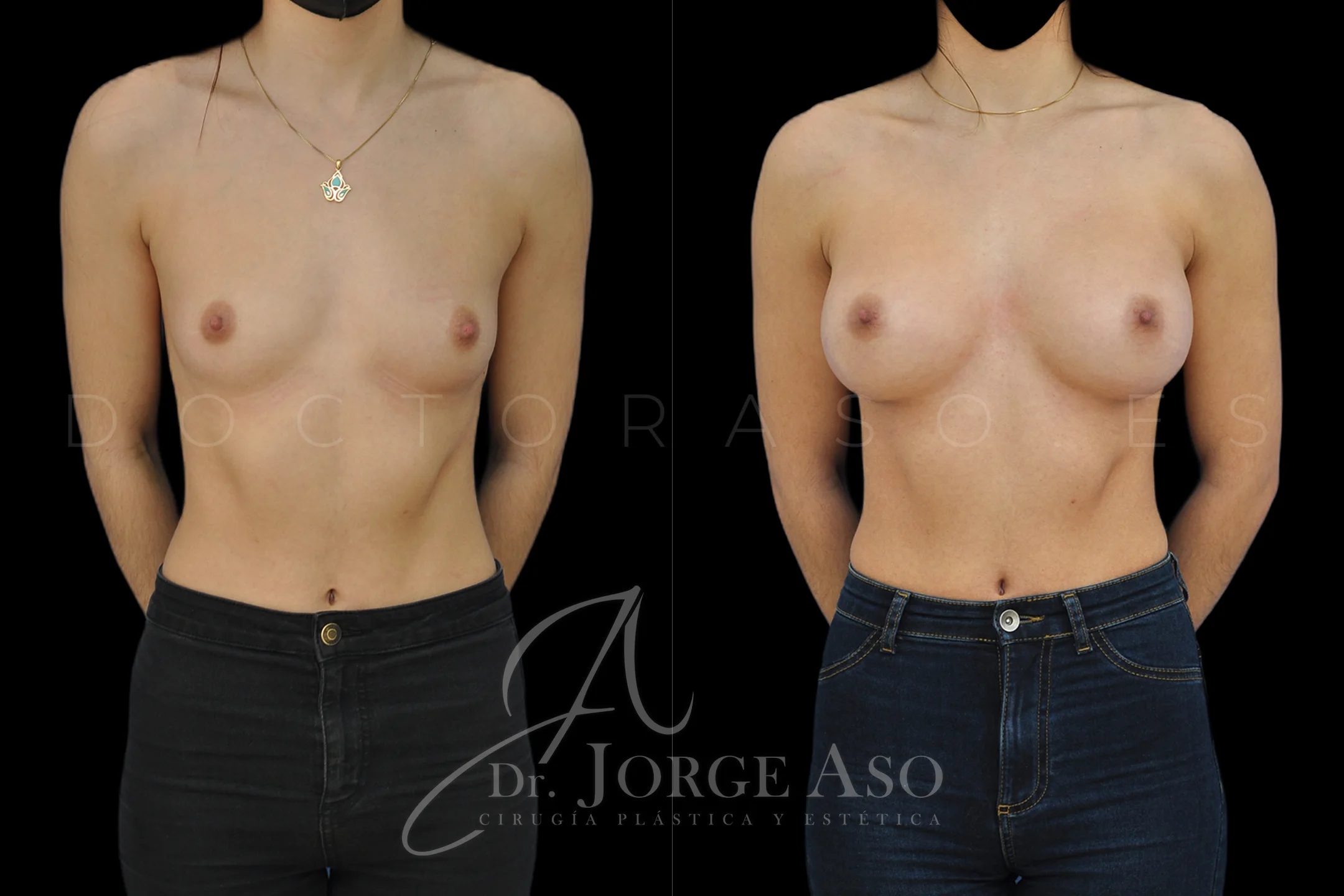 Aumento de pecho con protesis Ergonómicas de 400 cc perfil Alto (High Motiva) vista frontal