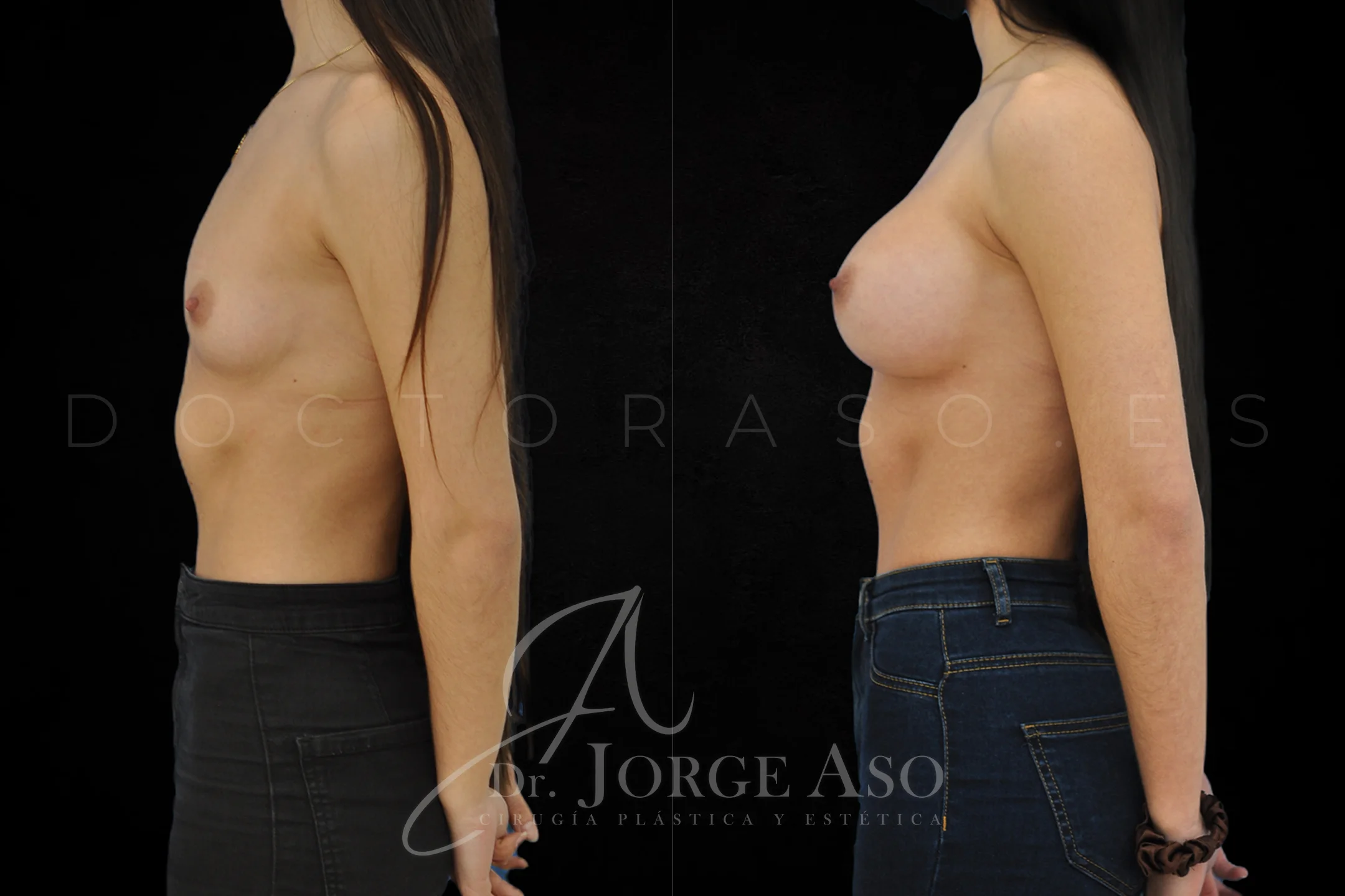 Aumento de pecho con protesis Ergonómicas de 400 cc perfil Alto (High Motiva) vista lateral