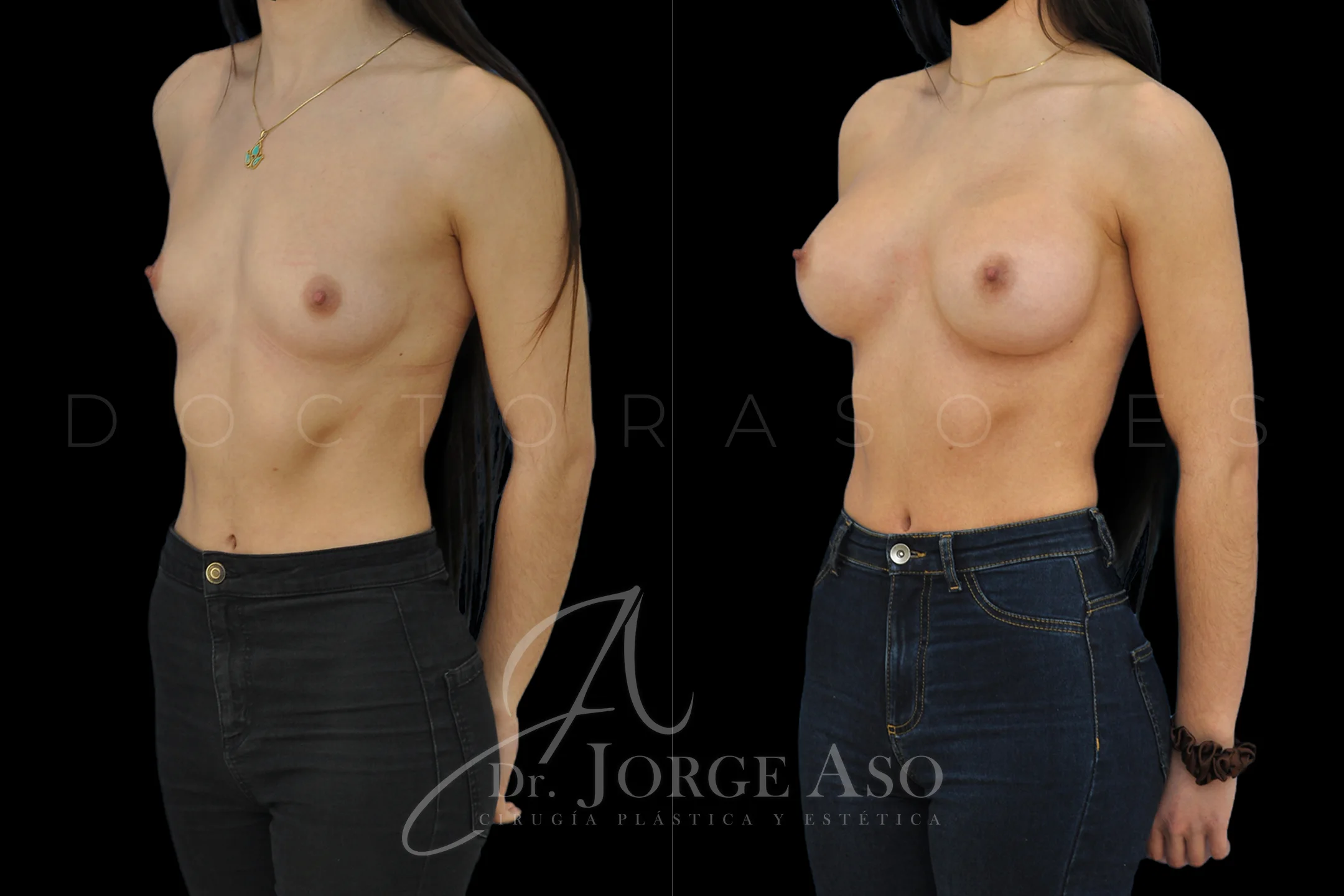 Aumento de pecho con protesis Ergonómicas de 400 cc perfil Alto (High Motiva) vista oblicua