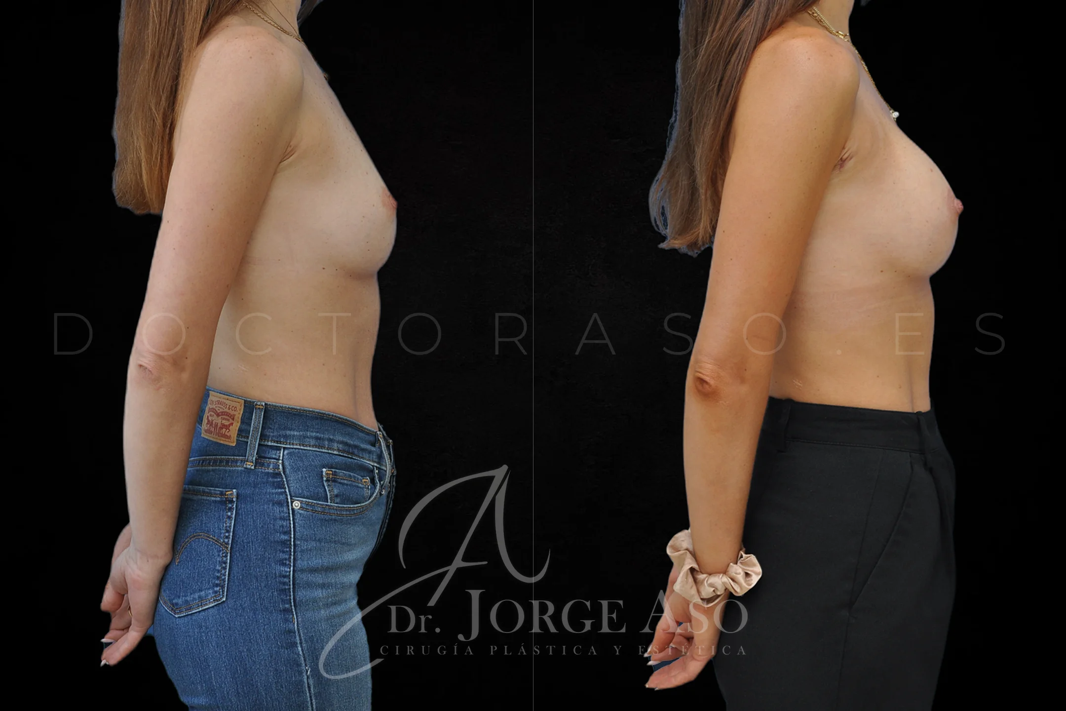 Aumento de pecho con Técnica MIA-Femtech y protesis MIA de 190 cc perfil Bajo por vía axilar vista lateral