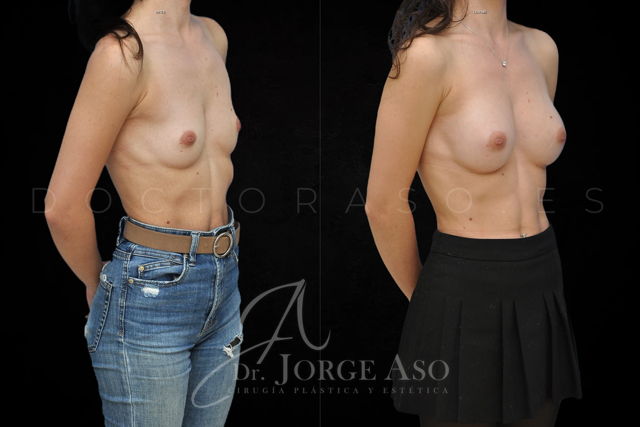 Aumento de pecho con Técnica MIA Femtech y implantes Diamond de Motiva de 195 cc perfil Moderado (Demi Motiva) por vía axilar vista oblicua