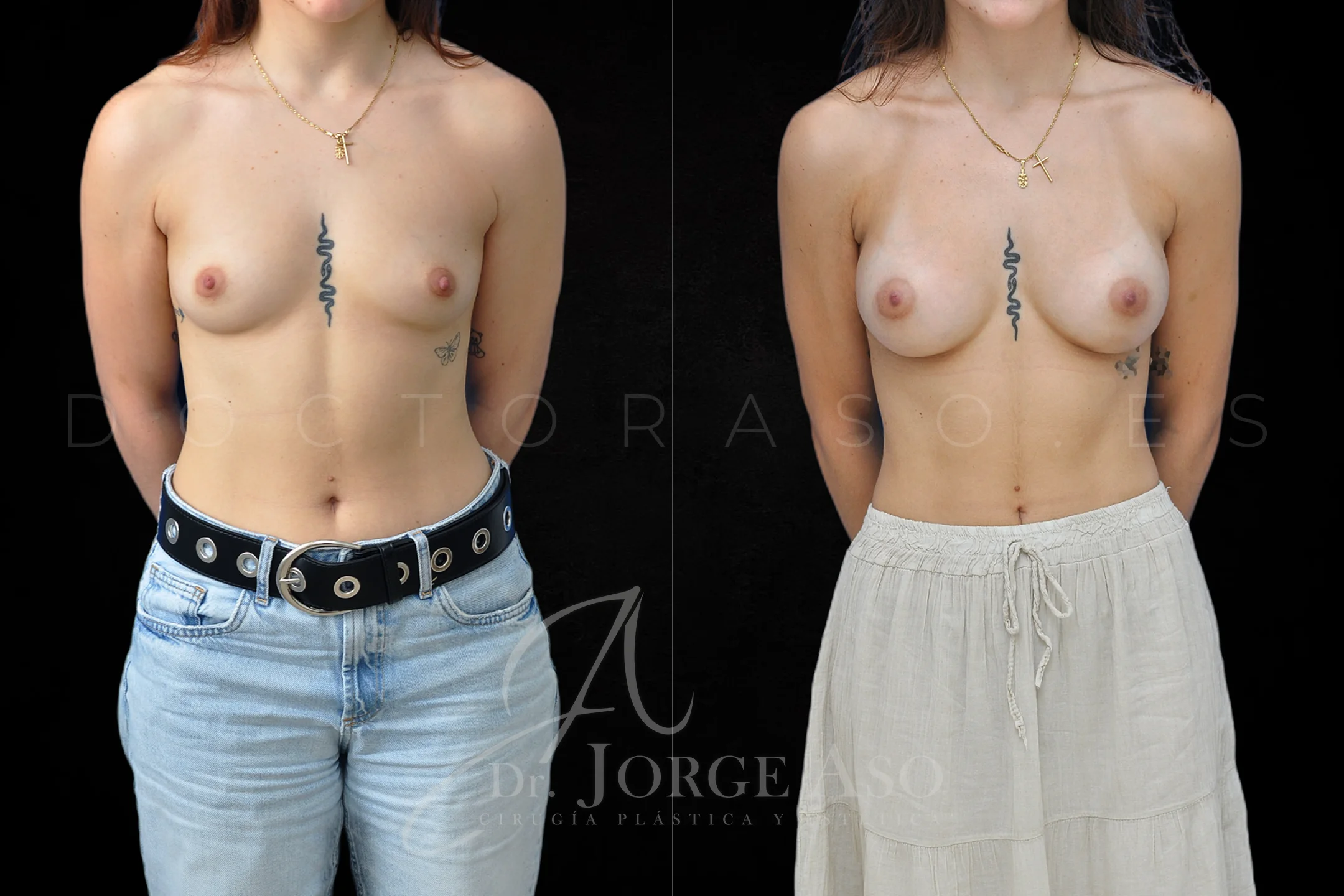 Aumento de pecho con Técnica MIA-Femtech y protesis MIA de 195 cc perfil Moderado (Demi Motiva) por vía axilar vista frontal