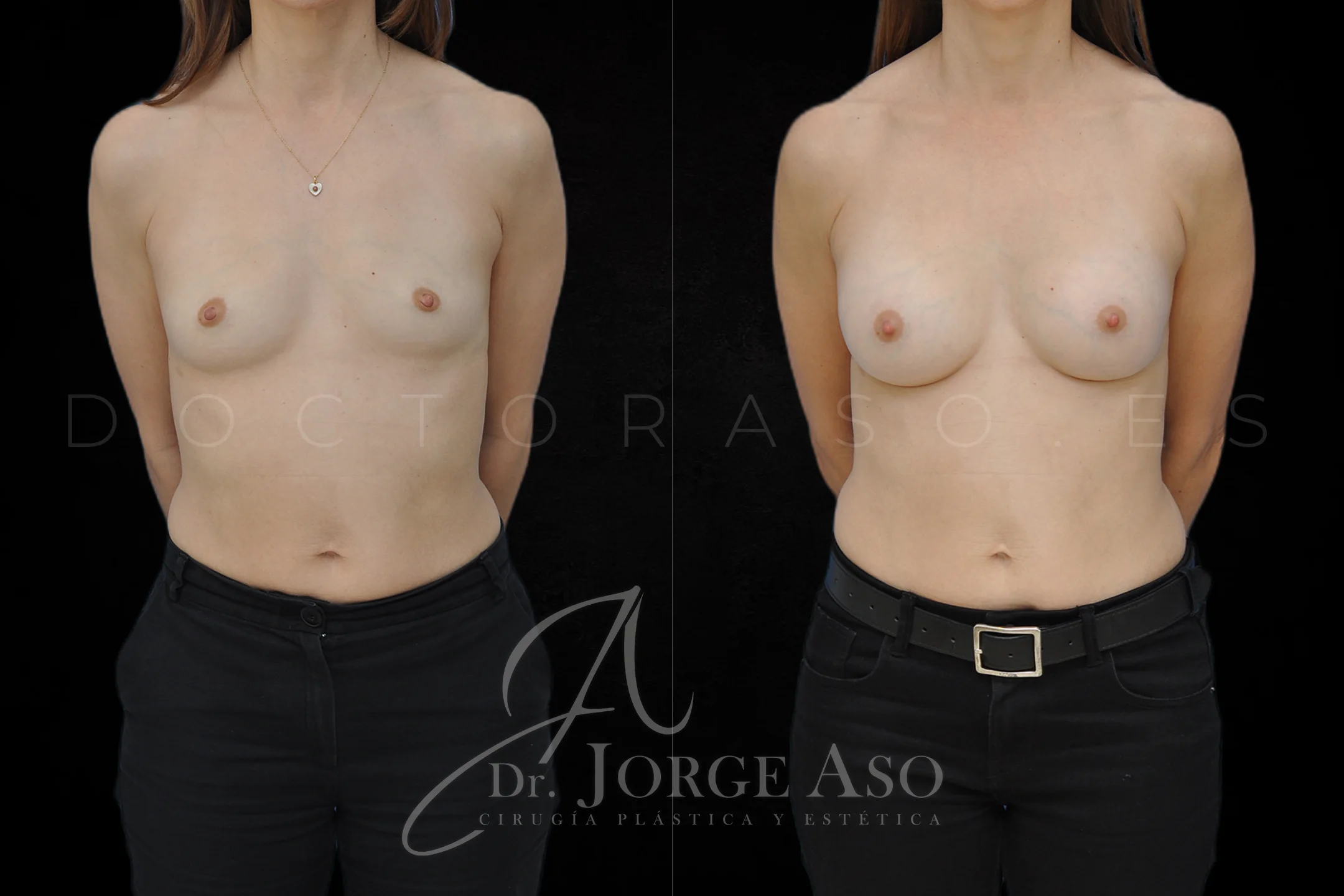Aumento de pecho con protesis Preservé de 225 cc perfil Moderado (Demi Motiva) vista frontal