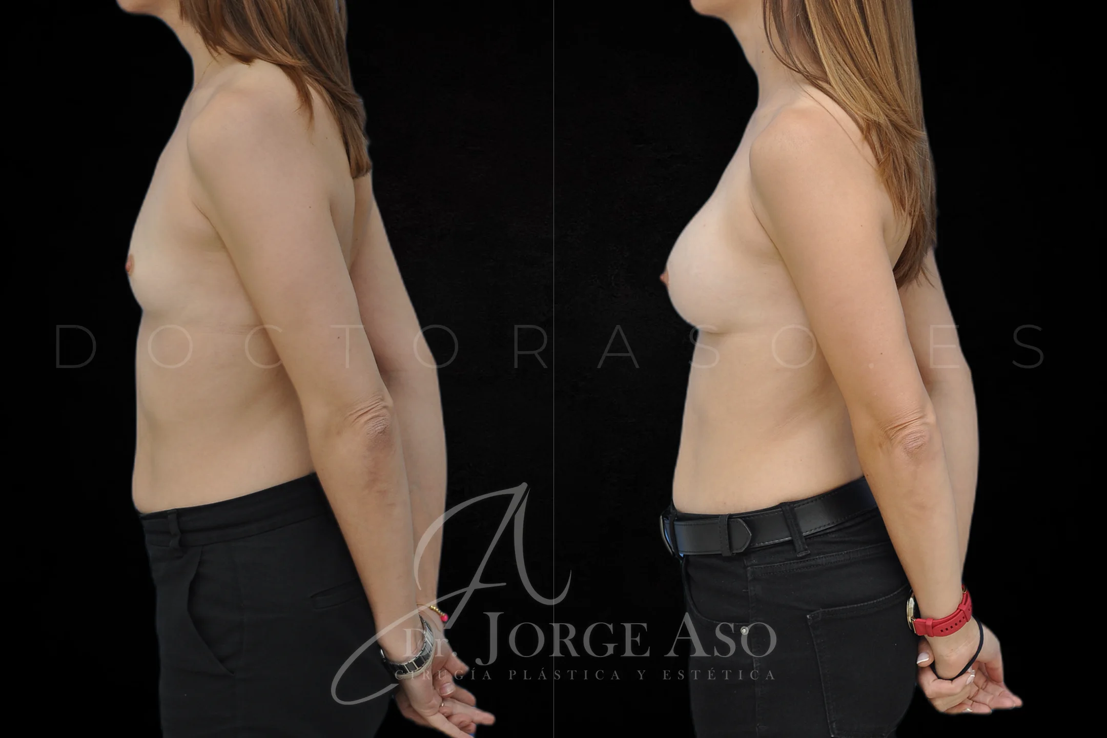 Aumento de pecho con protesis Preservé de 225 cc perfil Moderado (Demi Motiva) vista lateral