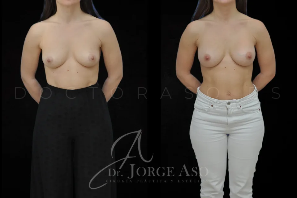 Clinical case of breast augmentation with Preservé technique and 250 cc Motiva Ergonomix2 ergonomic implants, moderate (demi motiva) profile, front view, before and after.