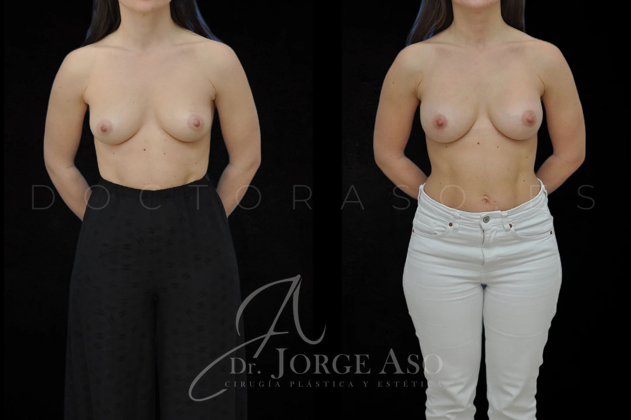 Aumento de pecho con protesis Preservé de 250 cc perfil Moderado (Demi Motiva) vista frontal