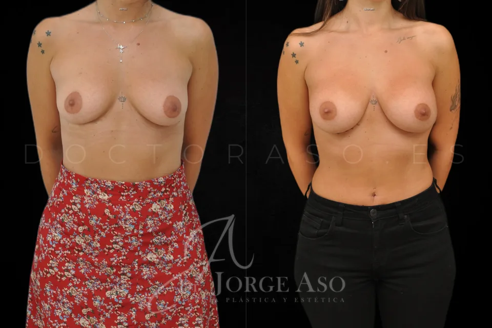 Clinical case of breast augmentation with Preservé technique and 270 cc Motiva Ergonomix2 ergonomic implants, moderate (demi motiva) profile, front view, before and after.