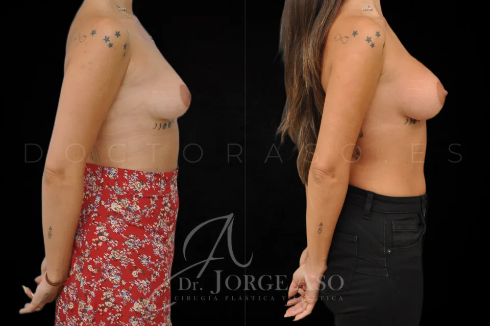 Aumento de pecho antes y después, técnica Preservé e implantes ergonómicos Motiva Ergonomix2, 270 cc, perfil moderado, vista lateral