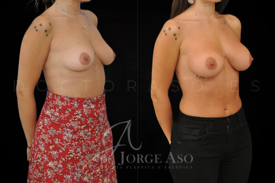 Aumento de pecho antes y después, técnica Preservé e implantes ergonómicos Motiva Ergonomix2, 270 cc, perfil moderado, vista oblicua