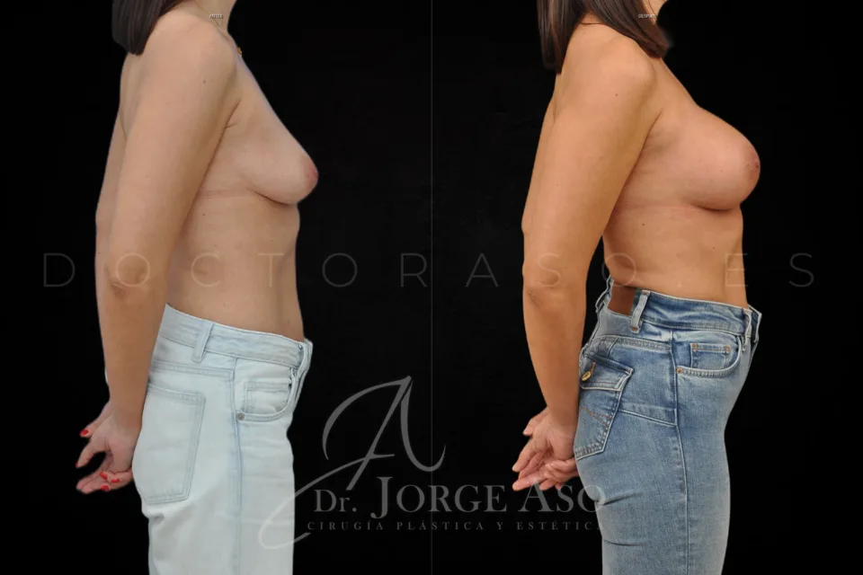 Aumento de pecho antes y después, técnica Preservé e implantes ergonómicos Motiva Ergonomix2, 285 cc, perfil moderado, vista lateral