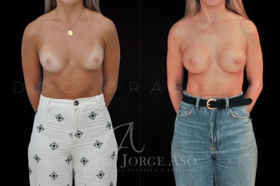 Clinical case of breast augmentation with Preservé technique and 285 cc Motiva Ergonomix2 ergonomic implants, moderate (demi motiva) profile, front view, before and after.