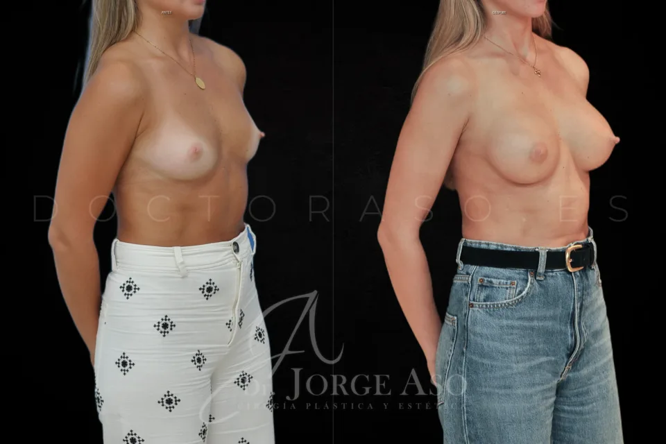 Aumento de pecho antes y después, técnica Preservé e implantes ergonómicos Motiva Ergonomix2, 285 cc, perfil moderado, vista oblicua