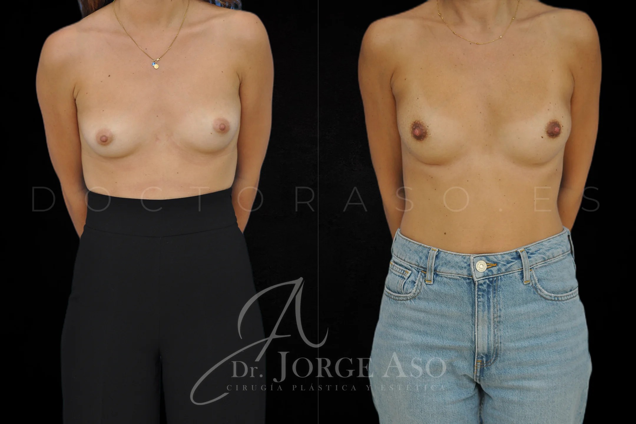 Aumento de pecho con protesis Redondas de 185 cc perfil Bajo vista frontal