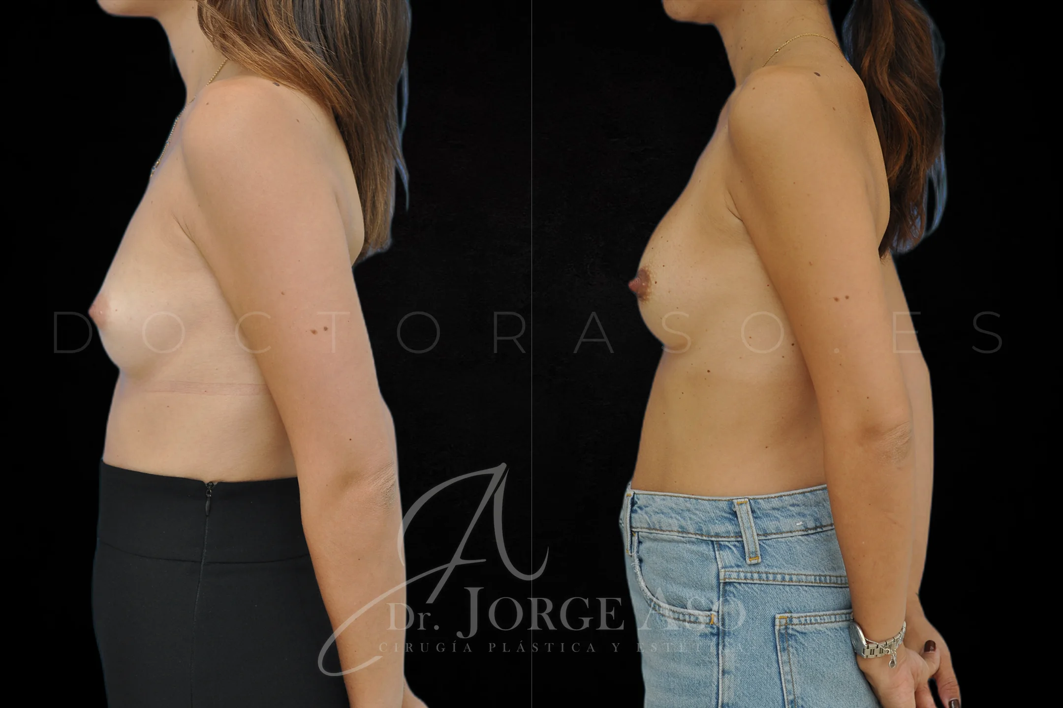 Aumento de pecho con protesis Redondas de 185 cc perfil Bajo vista lateral