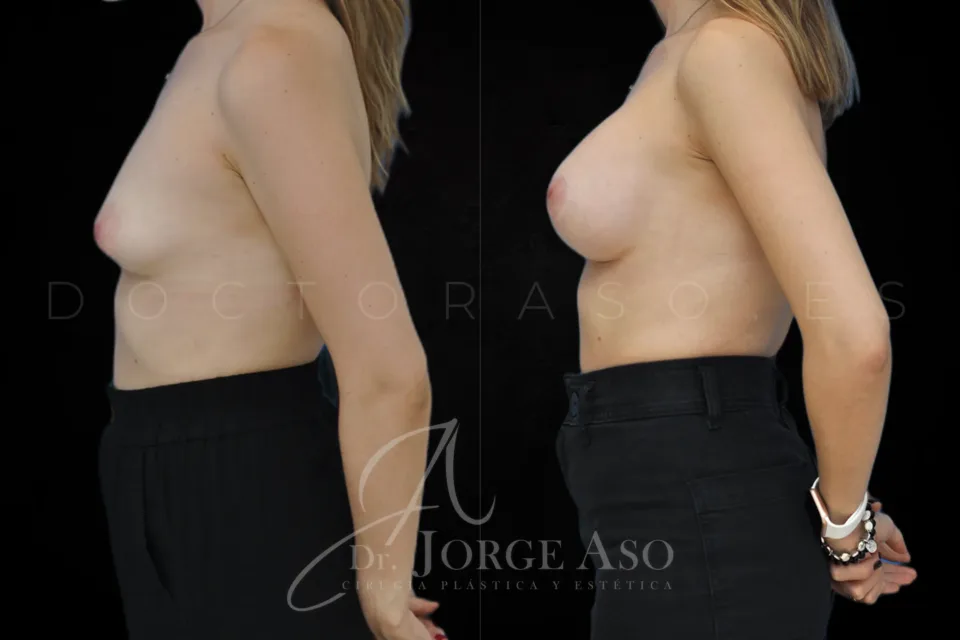 Aumento de pecho antes y después, prótesis redondas, 220 cc, perfil moderado, vista lateral