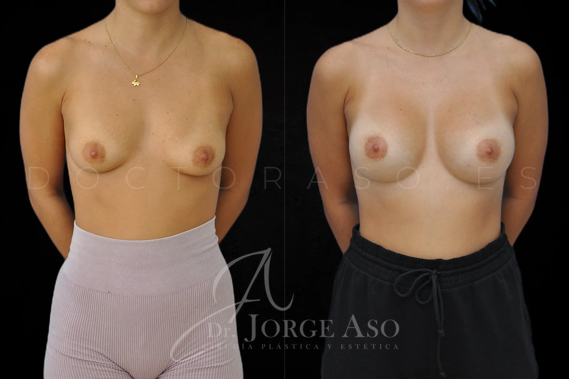 Aumento de pecho con protesis Redondas de 255 cc perfil Moderado vista frontal