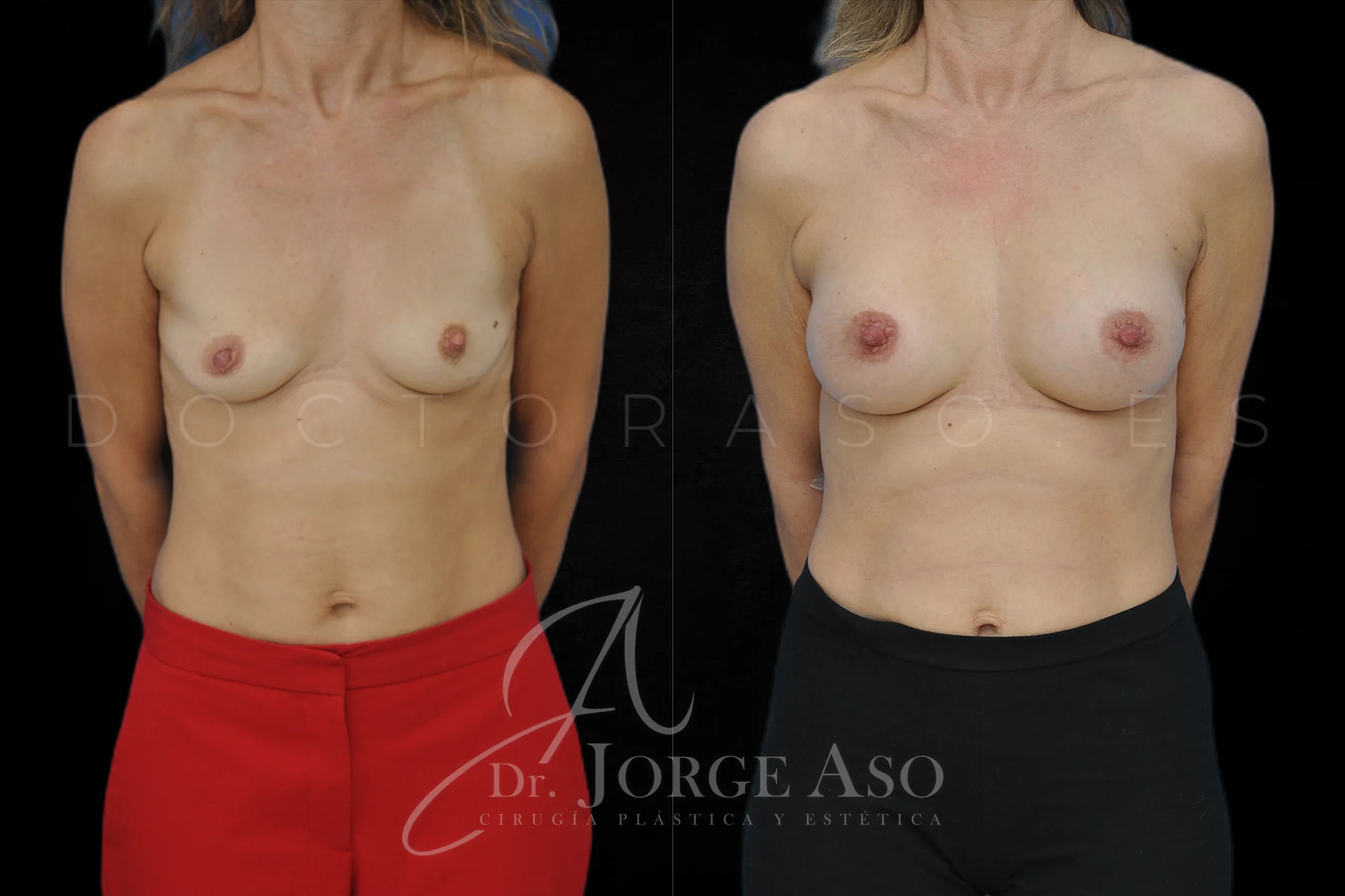 Aumento de pecho con protesis Redondas de 275 cc perfil Alto vista frontal