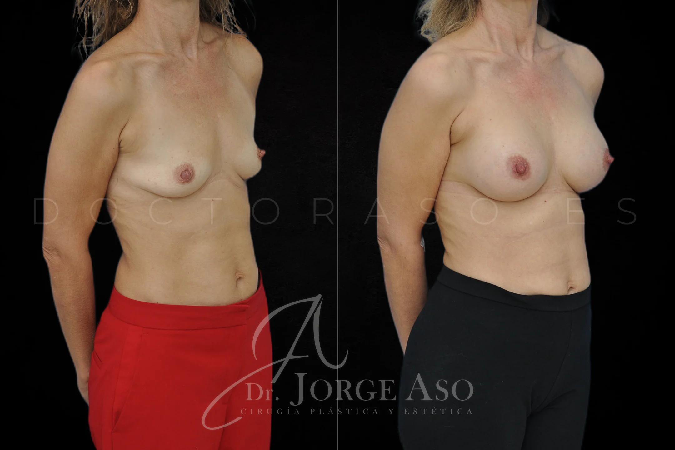 Aumento de pecho con protesis Redondas de 275 cc perfil Alto vista oblicua