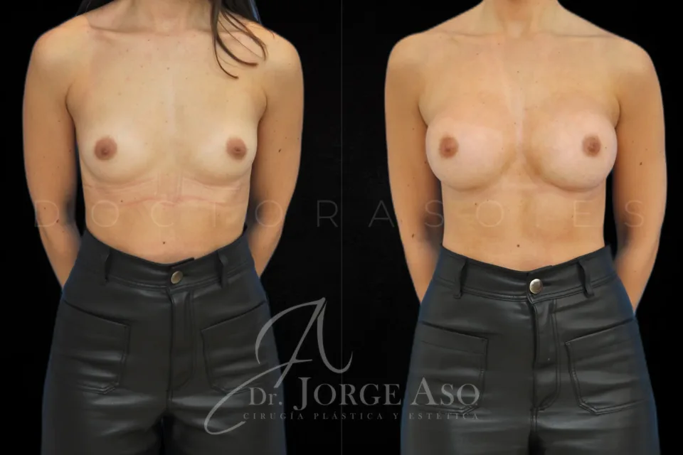 Clinical case of breast augmentation with 285 cc round implants, moderate profile, front view, before and after.