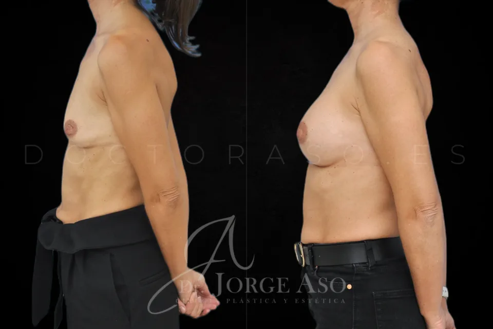 Aumento de pecho antes y después, prótesis redondas, 285 cc, perfil moderado, vista lateral