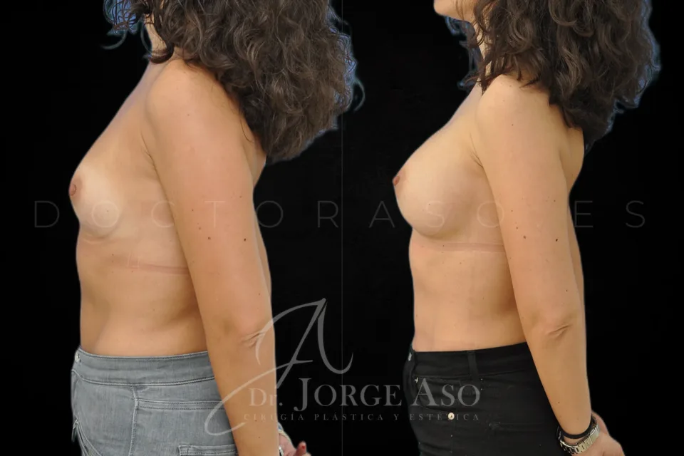 Aumento de pecho antes y después, prótesis redondas, 285 cc, perfil moderado, vista lateral