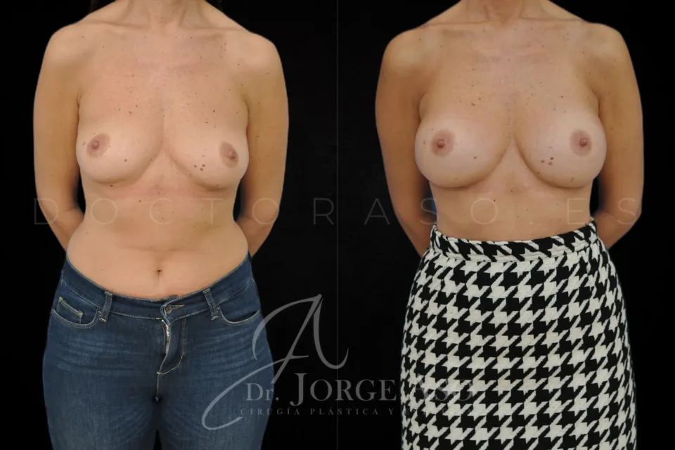 Clinical case of breast augmentation with 285 cc round implants, moderate profile, front view, before and after.