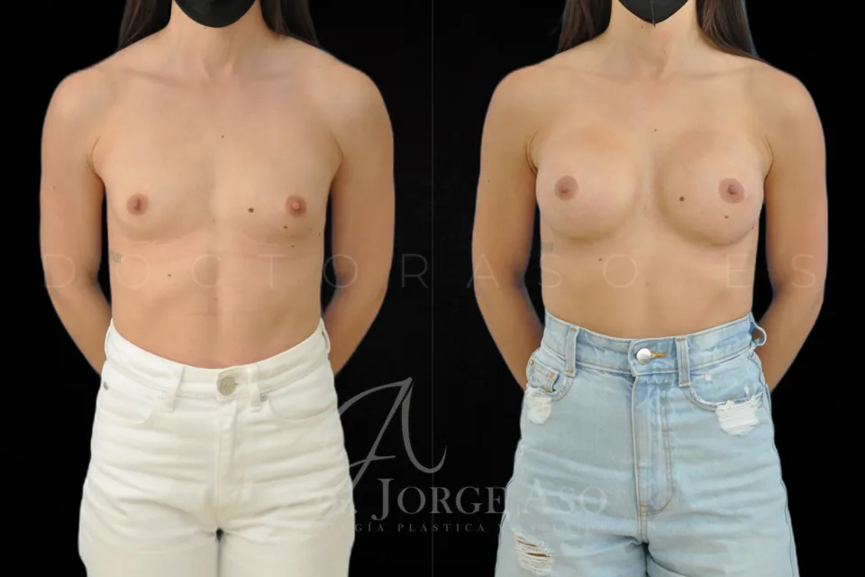 Clinical case of breast augmentation with 285 cc round implants, moderate profile, front view, before and after.