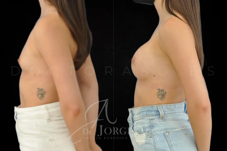 Aumento de pecho antes y después, prótesis redondas, 285 cc, perfil moderado, vista lateral