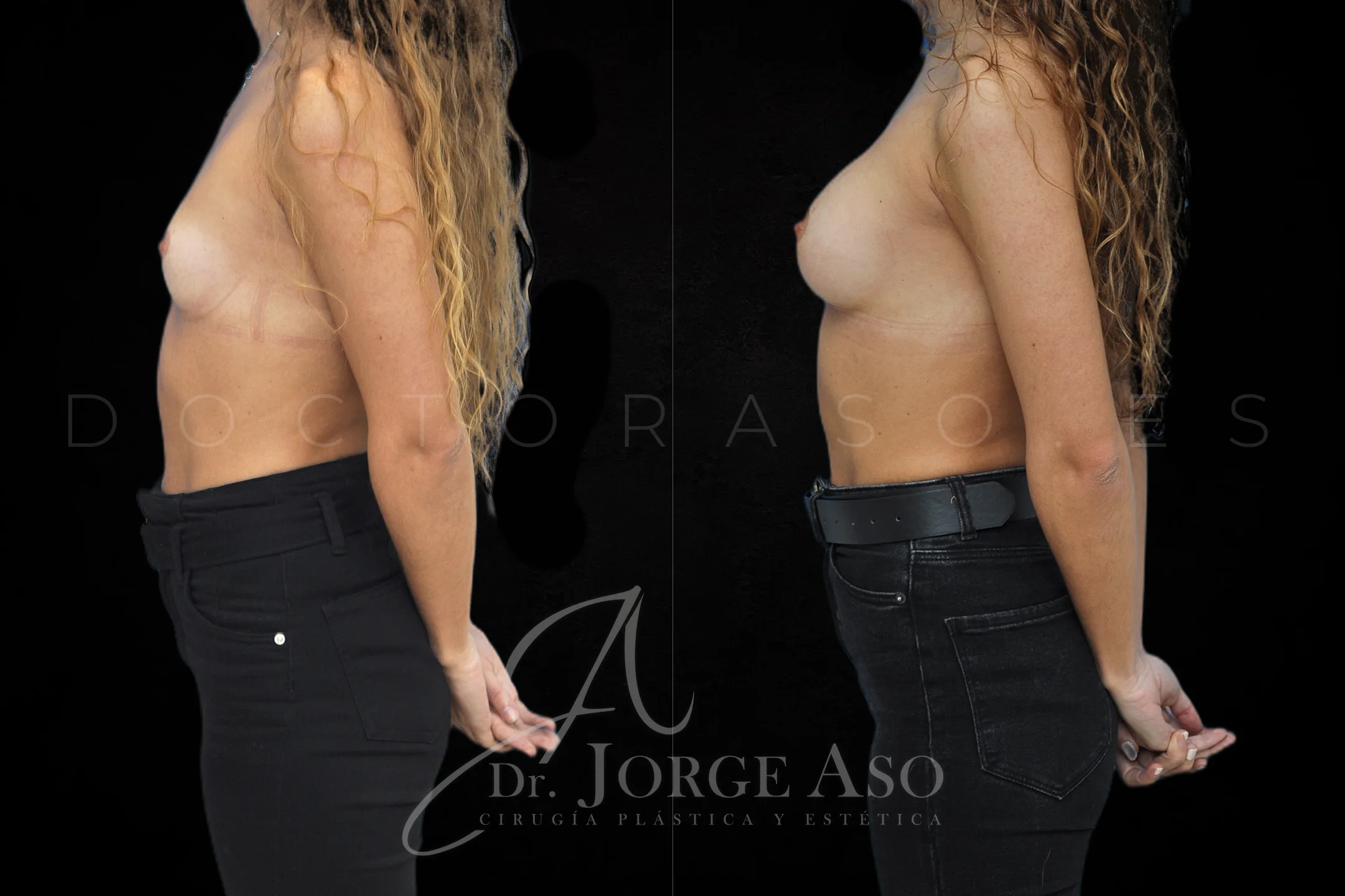 Aumento de pecho con protesis Redondas de 285 cc perfil Moderado vista lateral