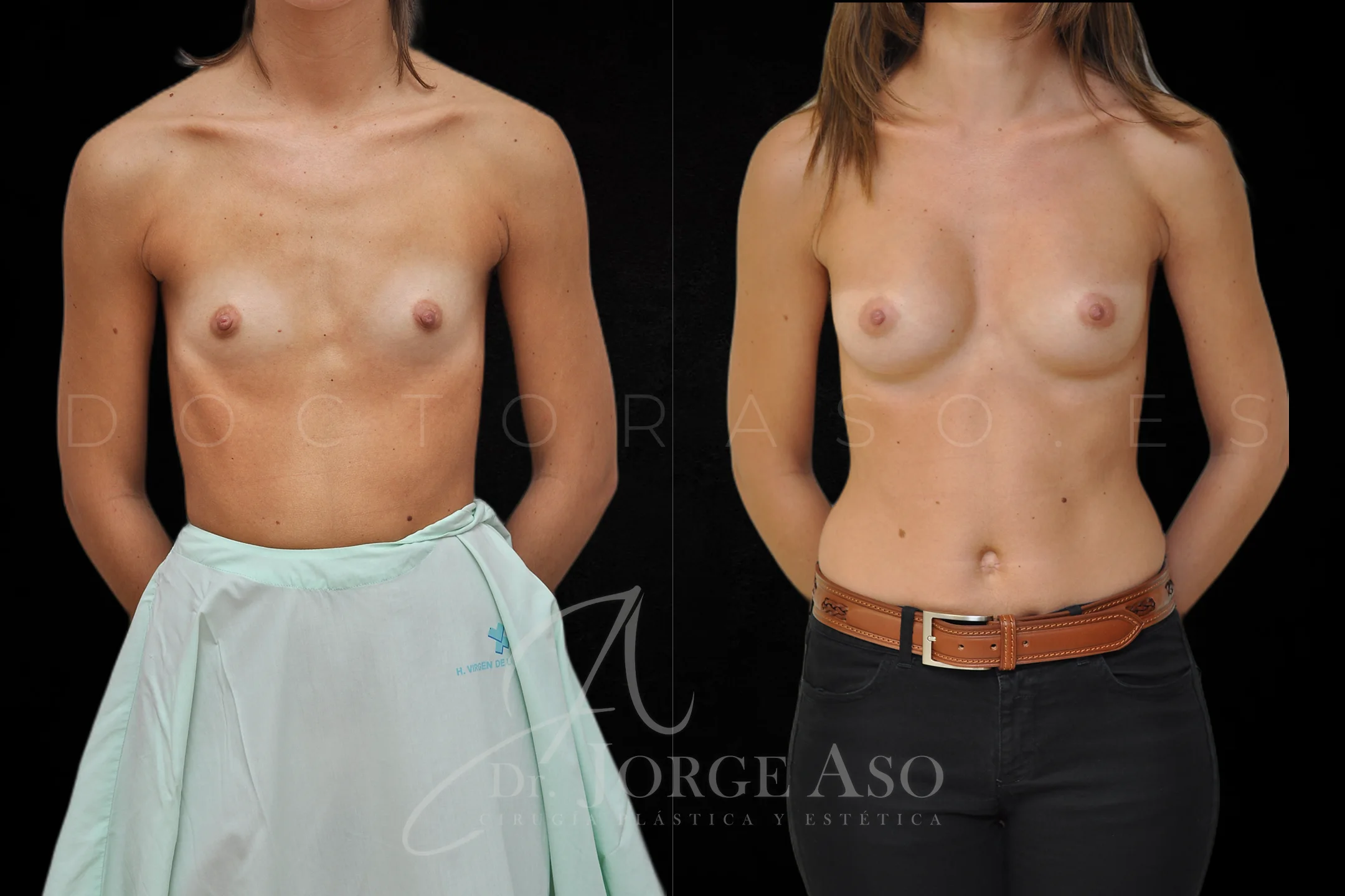 Aumento de pecho con protesis Redondas de 295 cc perfil Alto vista frontal