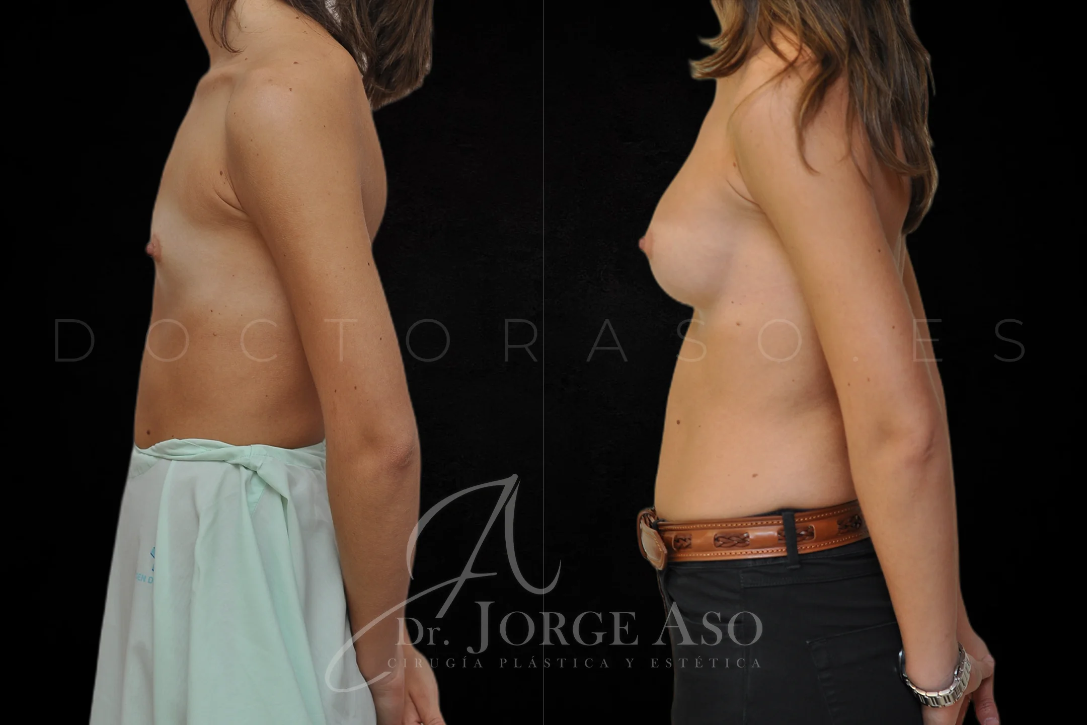Aumento de pecho con protesis Redondas de 295 cc perfil Alto vista lateral
