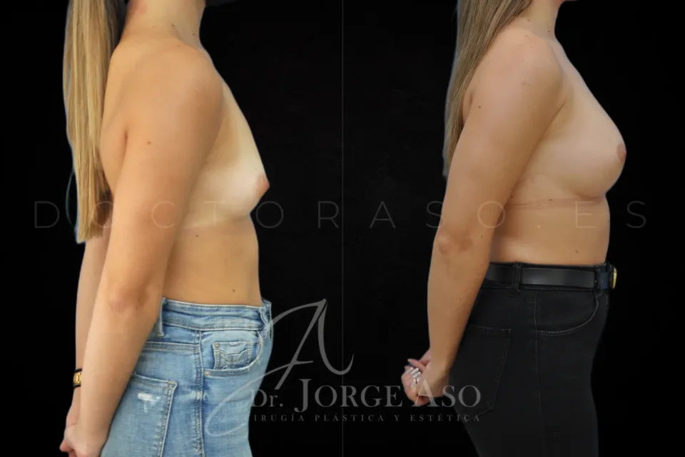 Aumento de pecho antes y después, prótesis redondas, 320 cc, perfil moderado, vista lateral