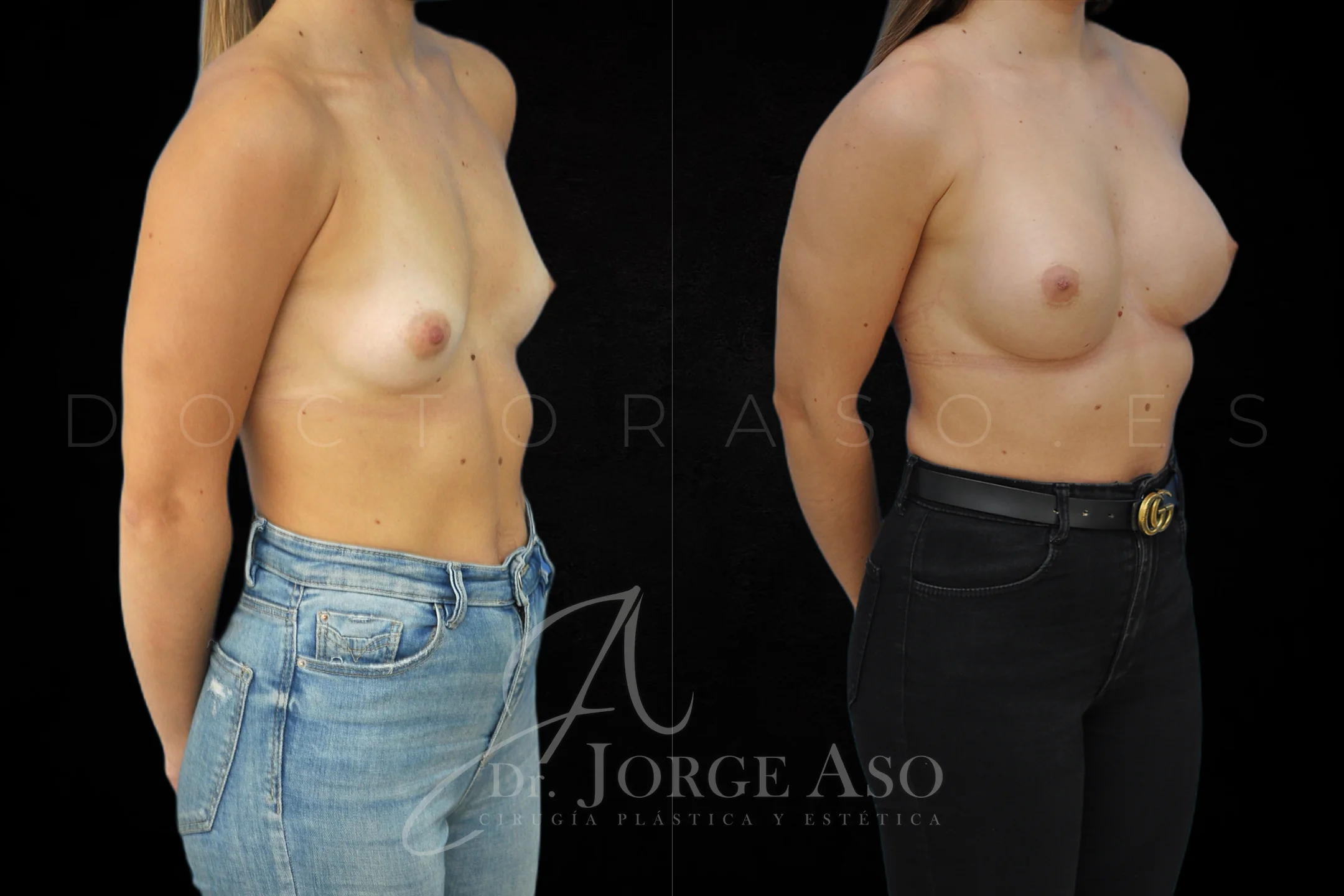 Aumento de pecho con protesis Redondas de 320 cc perfil Moderado vista oblicua